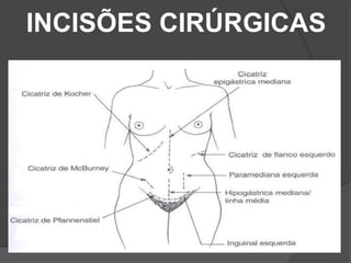 INCISÕES CIRÚRGICAS
 