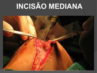 INCISÃO MEDIANA
 