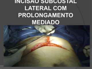 INCISÃO SUBCOSTAL
LATERAL COM
PROLONGAMENTO
MEDIADO
 