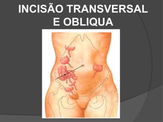 INCISÃO TRANSVERSAL
E OBLIQUA
 