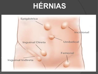 HÉRNIAS
 