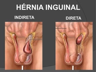 HÉRNIA INGUINAL
INDIRETA DIRETA
 