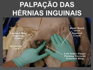 PALPAÇÃO DAS
HÉRNIAS INGUINAIS
 