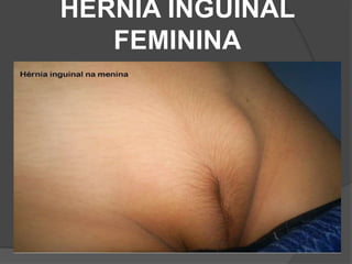 HÉRNIA INGUINAL
FEMININA
 
