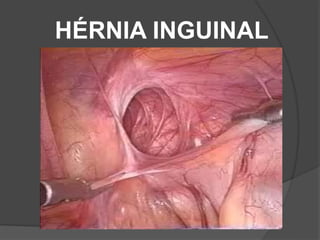 HÉRNIA INGUINAL
 