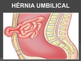 HÉRNIA UMBILICAL
 