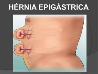 HÉRNIA EPIGÁSTRICA
 