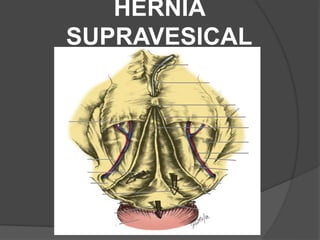HÉRNIA
SUPRAVESICAL
 