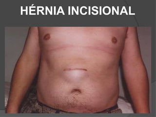 HÉRNIA INCISIONAL
 