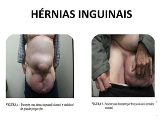 HÉRNIAS INGUINAIS
 