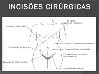 INCISÕES CIRÚRGICAS
 