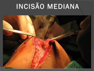 INCISÃO MEDIANA
 