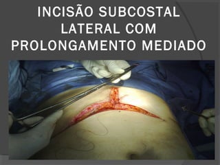 INCISÃO SUBCOSTAL
LATERAL COM
PROLONGAMENTO MEDIADO
 