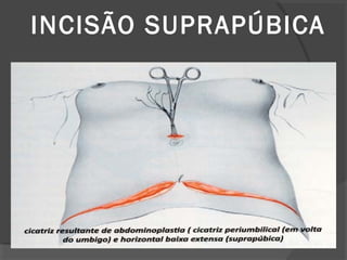 INCISÃO SUPRAPÚBICA
 