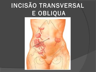INCISÃO TRANSVERSAL
E OBLIQUA
 