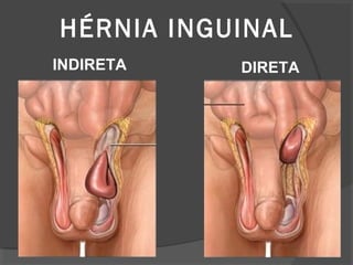 HÉRNIA INGUINAL
INDIRETA DIRETA
 