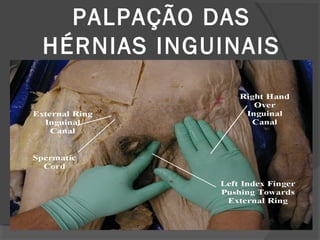 PALPAÇÃO DAS
HÉRNIAS INGUINAIS
 