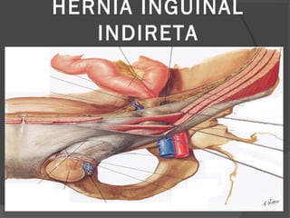 HÉRNIA INGUINAL
INDIRETA
 