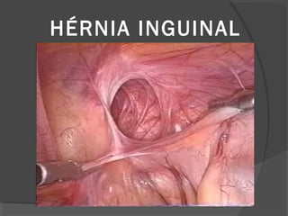 HÉRNIA INGUINAL
 