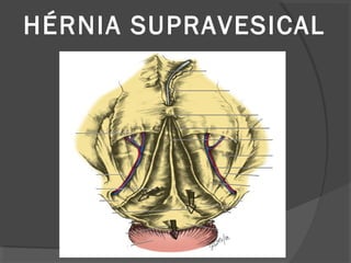 HÉRNIA SUPRAVESICAL
 