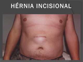 HÉRNIA INCISIONAL
 