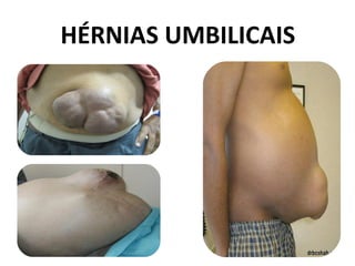 HÉRNIAS UMBILICAIS
 
