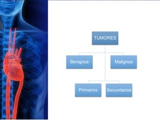 TUMORES
Primarios
Benignos
Secundarios
Malignos
 