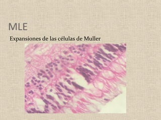 MLE
Expansiones de las células de Muller
 