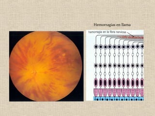 Hemorragias en llama
 