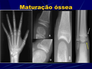 Maturação óssea 