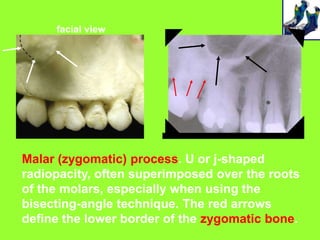 facial view




Malar (zygomatic) process. U or j-shaped
radiopacity, often superimposed over the roots
of the molars, especially when using the
bisecting-angle technique. The red arrows
define the lower border of the zygomatic bone.
 