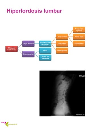 Hiperlordosis lumbar
Músculos
involucrados
Grupo Posterior
Plano Profundo
(espinales)
Masa común
Transverso
espinoso
Dorsal largo
SacrolumbarEpiespinoso
Interespinoso
Grupo anterior
Psoas
Pilares del
diafragma
 