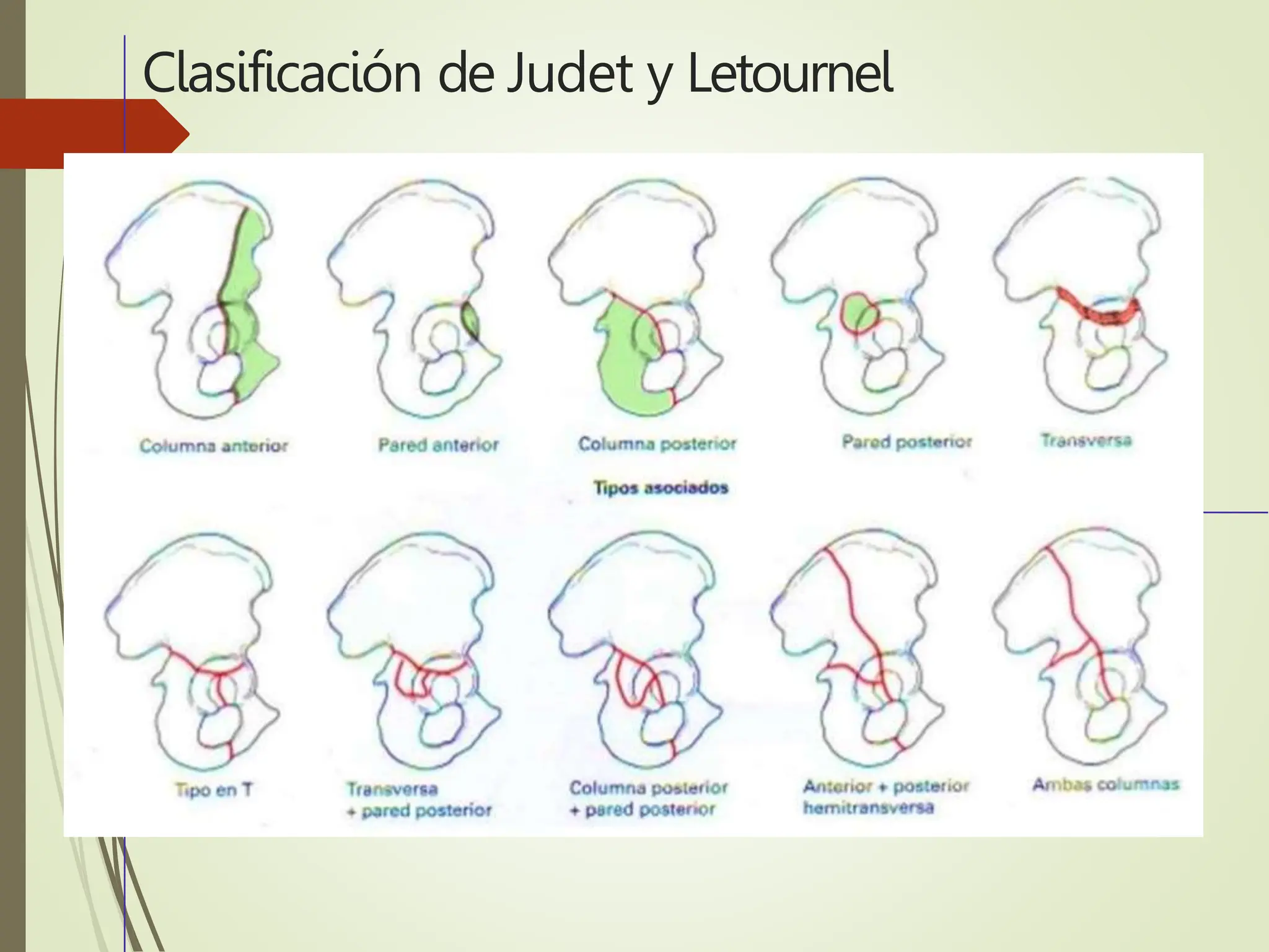 ANATOMIA ACETABULO - PSEUDOARTROSIS.pptx