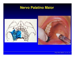 Prof. Peter Reher, CD, MSc, PhDProf. Peter Reher,Prof. Peter Reher, CD,CD, MScMSc,, PhDPhD
Nervo Palatino MaiorNervo Palatino MaiorNervo Palatino Maior
 