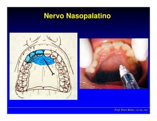 Prof. Peter Reher, CD, MSc, PhDProf. Peter Reher,Prof. Peter Reher, CD,CD, MScMSc,, PhDPhD
Nervo NasopalatinoNervoNervo NasopalatinoNasopalatino
 