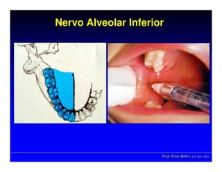 Prof. Peter Reher, CD, MSc, PhDProf. Peter Reher,Prof. Peter Reher, CD,CD, MScMSc,, PhDPhD
Nervo Alveolar InferiorNervo Alveolar InferiorNervo Alveolar Inferior
 