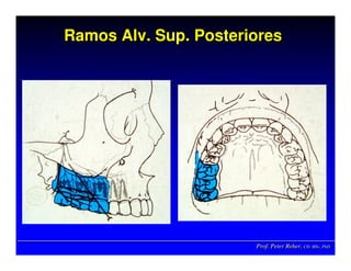 Prof. Peter Reher, CD, MSc, PhDProf. Peter Reher,Prof. Peter Reher, CD,CD, MScMSc,, PhDPhD
Ramos Alv. Sup. PosterioresRamosRamos AlvAlv.. SupSup. Posteriores. Posteriores
 