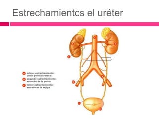 Estrechamientos el uréter 
 