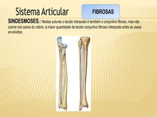 SistemaArticular
SINDESMOSES.: Nestas suturas o tecido interposto é também o conjuntivo fibroso, mas não
ocorre nos ossos do crânio. á maior quantidade de tecido conjuntivo fibroso interposto entre os ossos
envolvidos
FIBROSAS
 