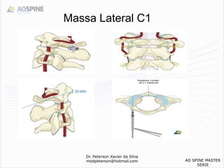 Dr. Peterson Xavier da Silva
medpeterson@hotmail.com
Massa Lateral C1
AO SPINE MASTER
SERIE
 