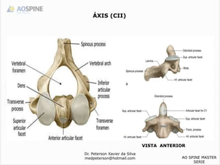 ÁXIS (CII)
VISTA ANTERIOR
Dr. Peterson Xavier da Silva
medpeterson@hotmail.com AO SPINE MASTER
SERIE
 