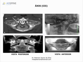 ÁXIS (CII)
VISTA ANTERIOR
Dr. Peterson Xavier da Silva
medpeterson@hotmail.com
VISTA POSTERIOR
 