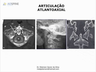 Dr. Peterson Xavier da Silva
medpeterson@hotmail.com
ARTICULAÇÃO
ATLANTOAXIAL
 
