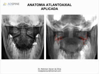 Dr. Peterson Xavier da Silva
medpeterson@hotmail.com
ANATOMIA ATLANTOAXIAL
APLICADA
 