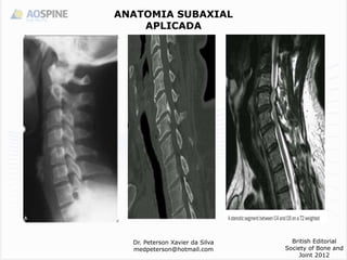Dr. Peterson Xavier da Silva
medpeterson@hotmail.com
British Editorial
Society of Bone and
Joint 2012
ANATOMIA SUBAXIAL
APLICADA
 