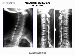 Dr. Peterson Xavier da Silva
medpeterson@hotmail.com
ANATOMIA SUBAXIAL
APLICADA
 