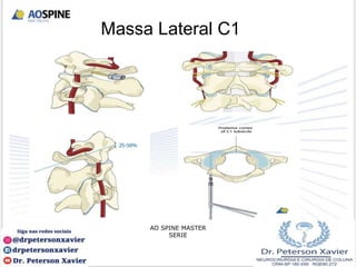 Massa Lateral C1
AO SPINE MASTER
SERIE
 