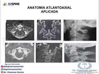 ANATOMIA ATLANTOAXIAL
APLICADA
 