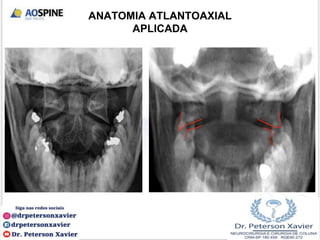 ANATOMIA ATLANTOAXIAL
APLICADA
 