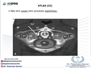 ATLAS (CI)
• Não tem corpo nem processo espinhoso;
 